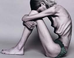 Anorexia Nerviosa - Trastornos de la Conducta Alimentaria Dexeus