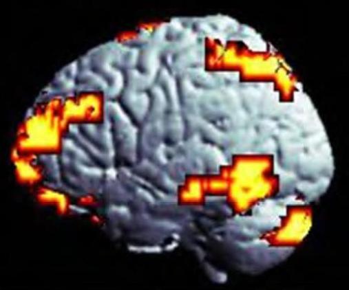 Alteraciones neuroanatómicas en el adulto con TDAH